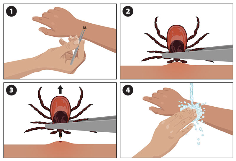 This illustration shows how to remove a tick (Ixodes scapularis pictured). 